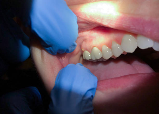 Best Emergency Treatment for Dental Infections or Abscesses in Blue Hills, CT